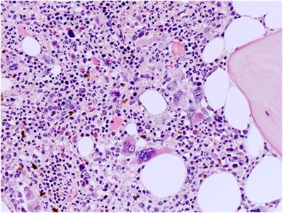 Chronic myeloproliferative neoplasms with concomitant CALR mutation and BCR::ABL1 translocation: diagnostic and therapeutic implications of a rare hybrid disease